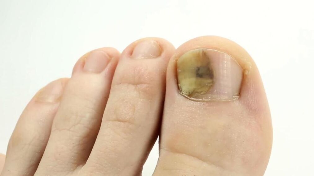 View of the toenail affected by the fungus